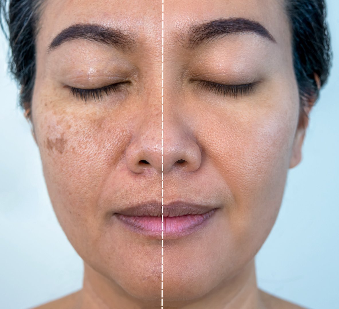5 Best Dark-Spot Products to Support a Melasma Routine article image