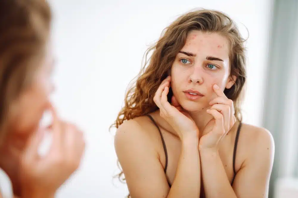 5 Best Face Washes for Hormonal Acne article image