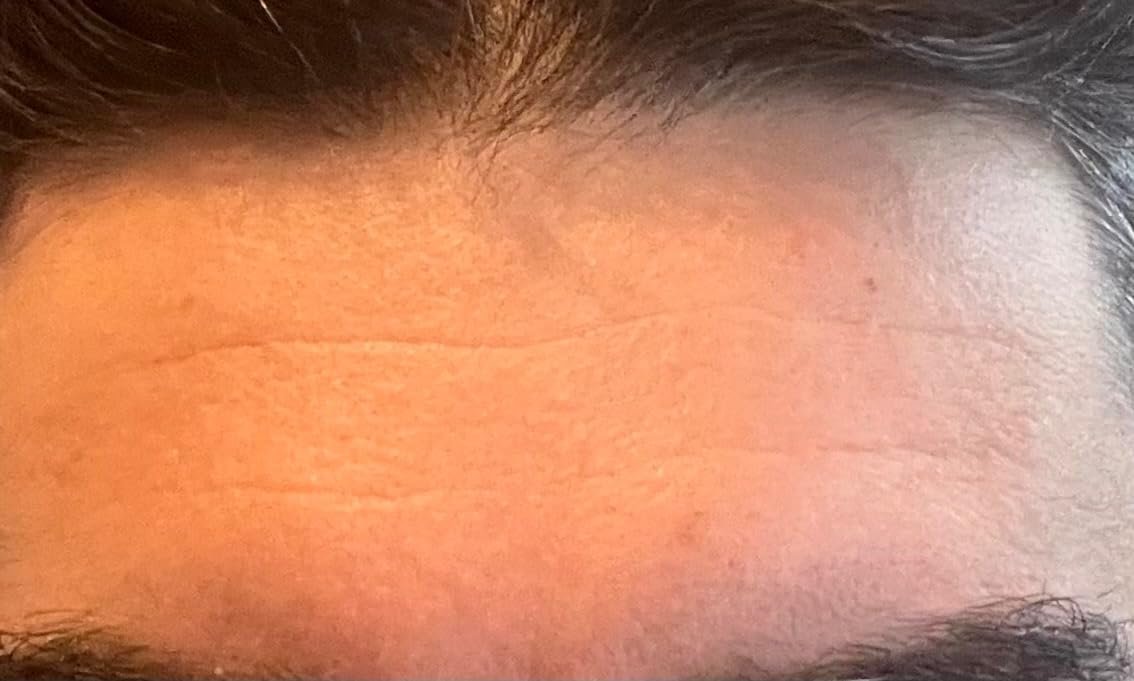 Supplied close-up forehead image associated with Olay Regenerist cream