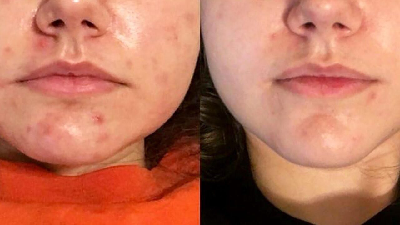 6 Best Face Oils for Acne-Prone Skin: Lightweight Picks article image