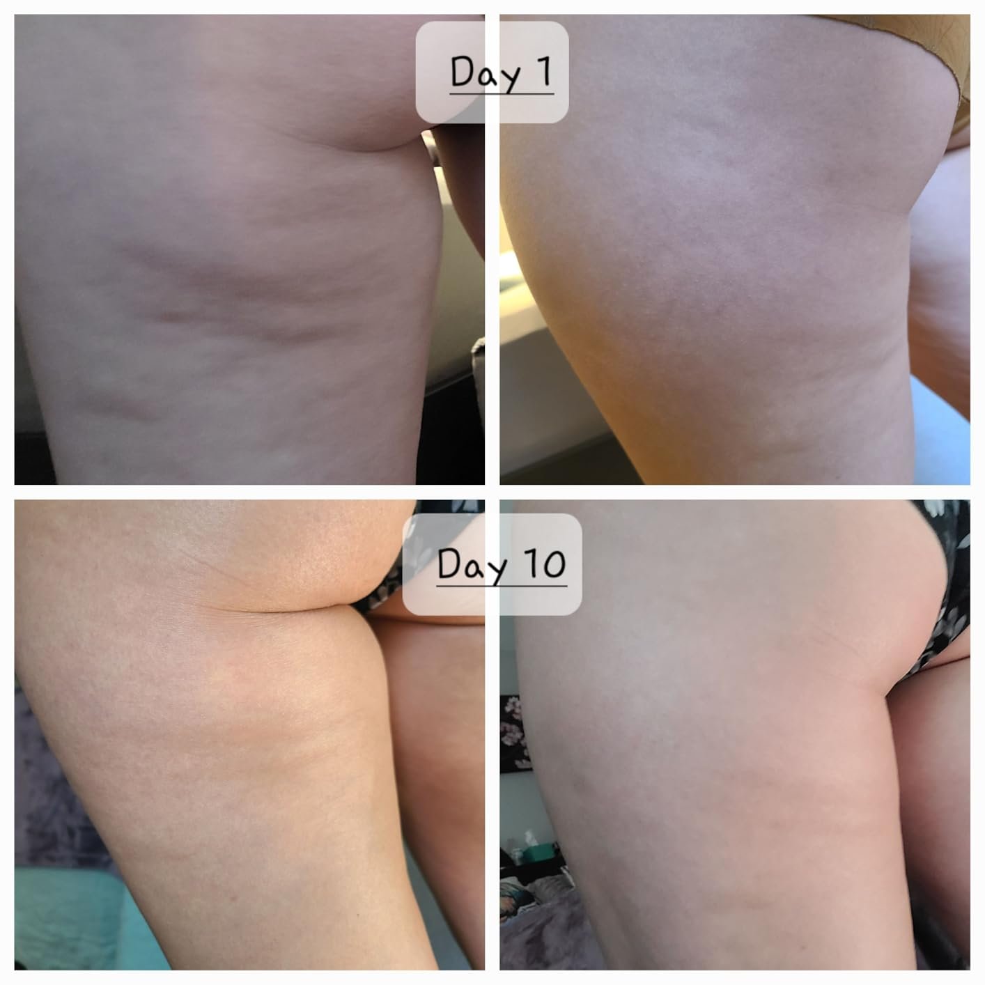 User-submitted Day 1 and Day 10 thigh collage paired with Advanced Clinicals Retinol Body Cream