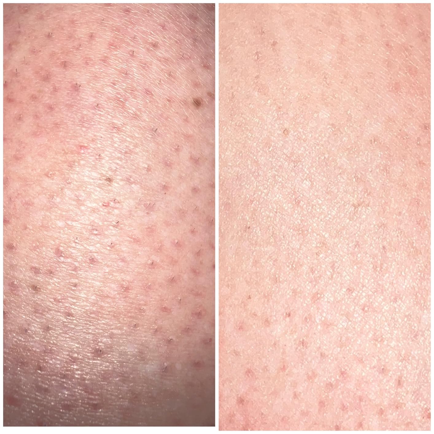 Customer-submitted close-up comparison of shaved skin for Bushbalm Nude Scrub