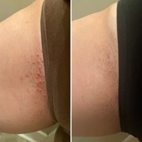 Customer-submitted outer bikini-line skin comparison for Bushbalm Watermelon Sugar Scrub