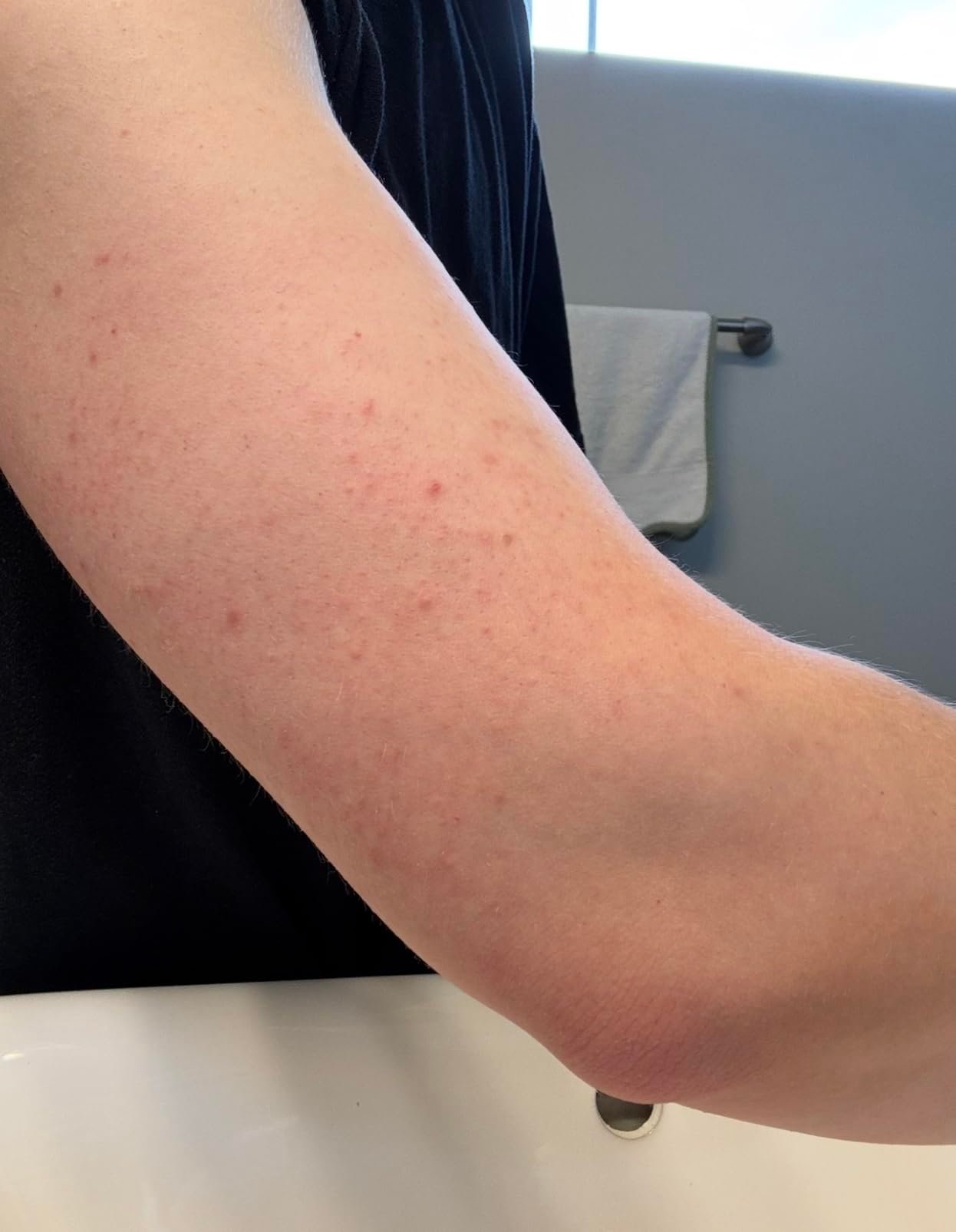 Customer-submitted upper-arm texture with visible bumps