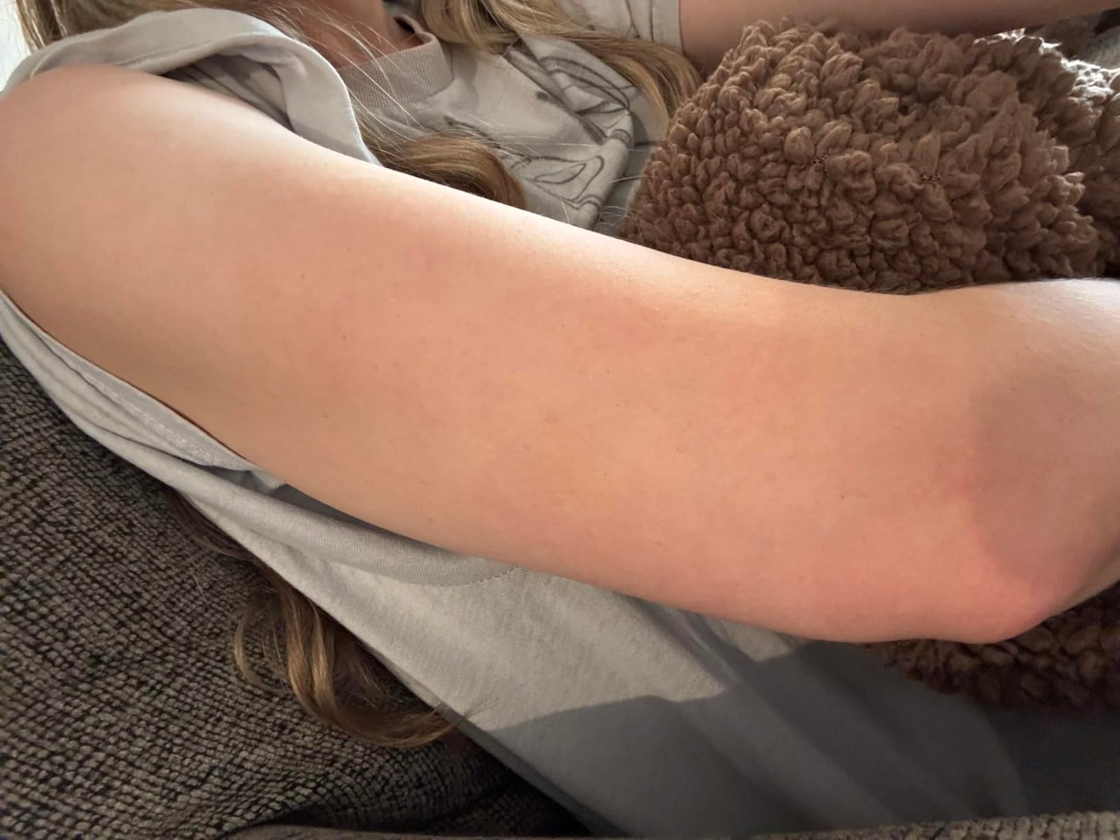 Additional customer-submitted upper-arm skin view