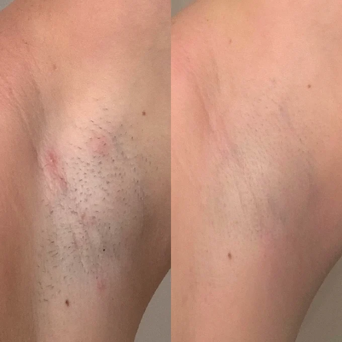 Customer-submitted underarm skin comparison for First Aid Beauty Ingrown Hair Pads
