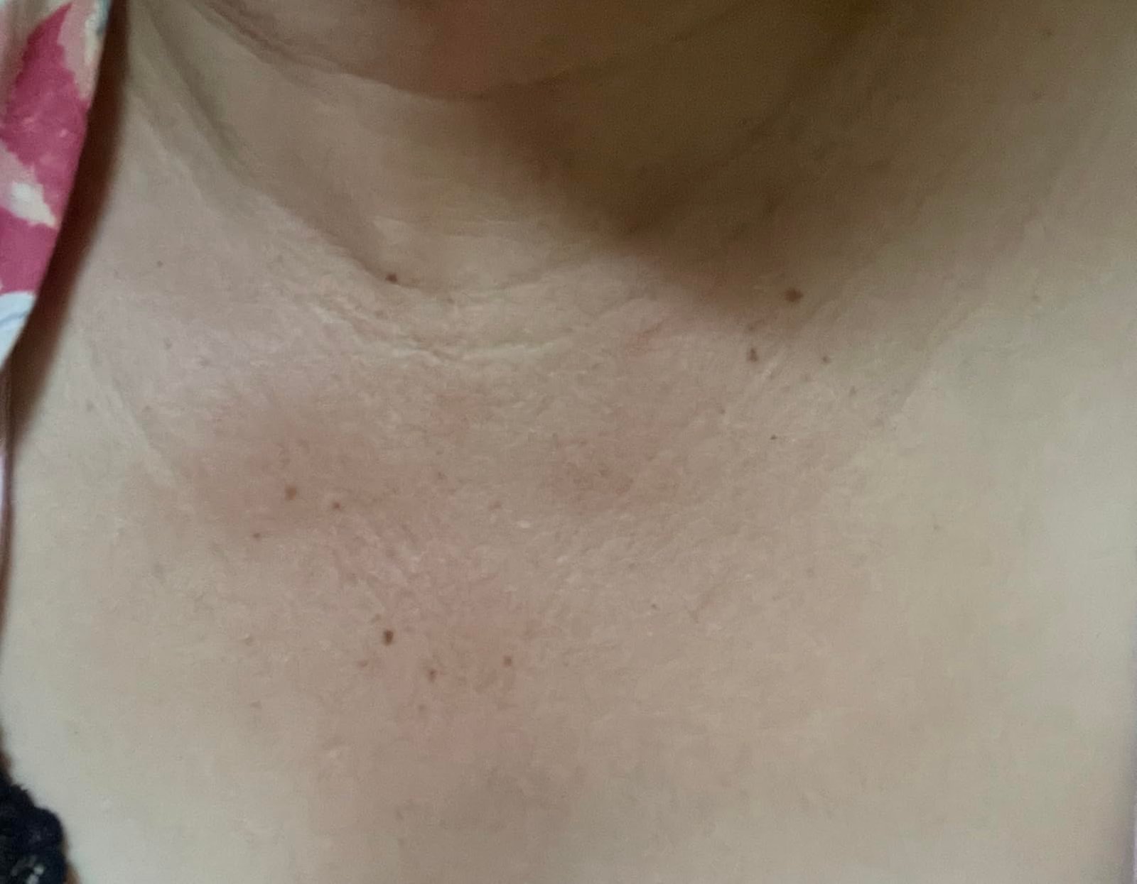 Second close-up of neck and chest skin paired with the Medix 5.5 body cream