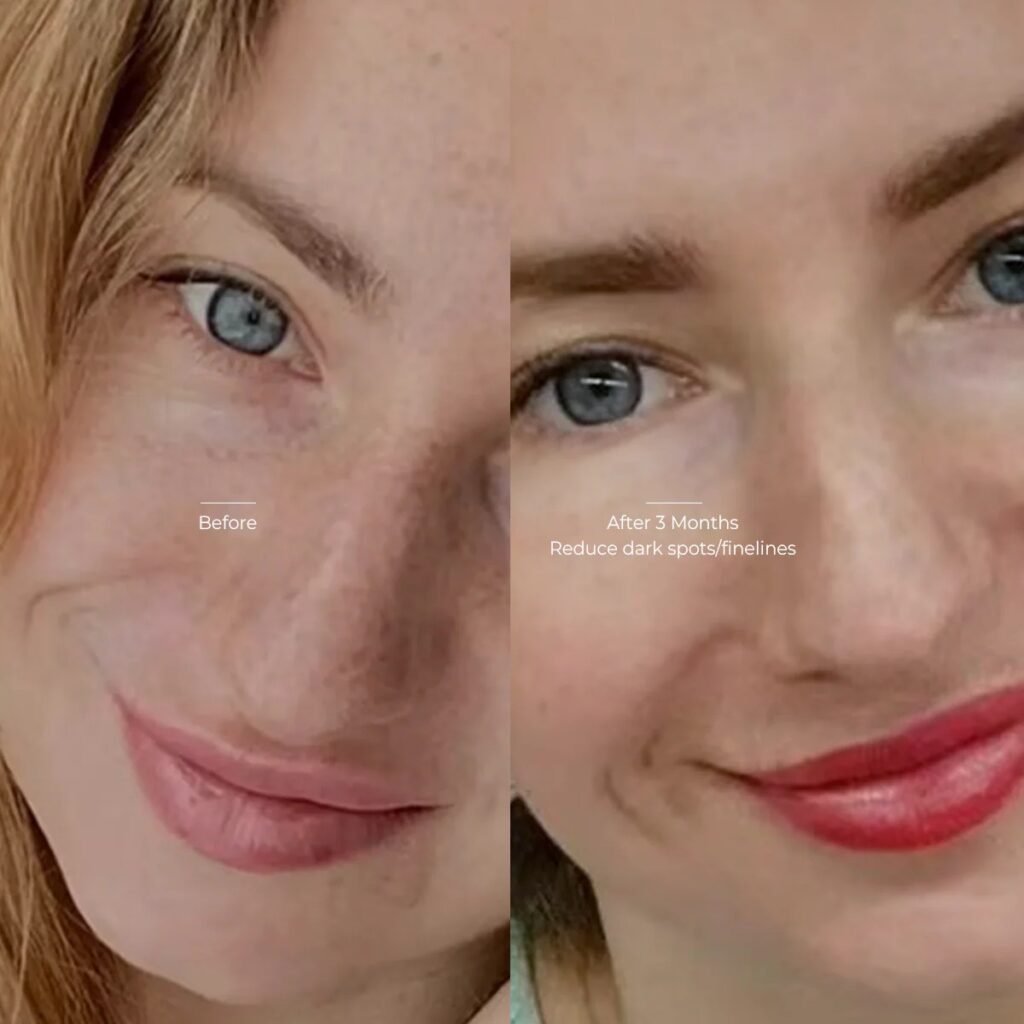 best led face mask for acne