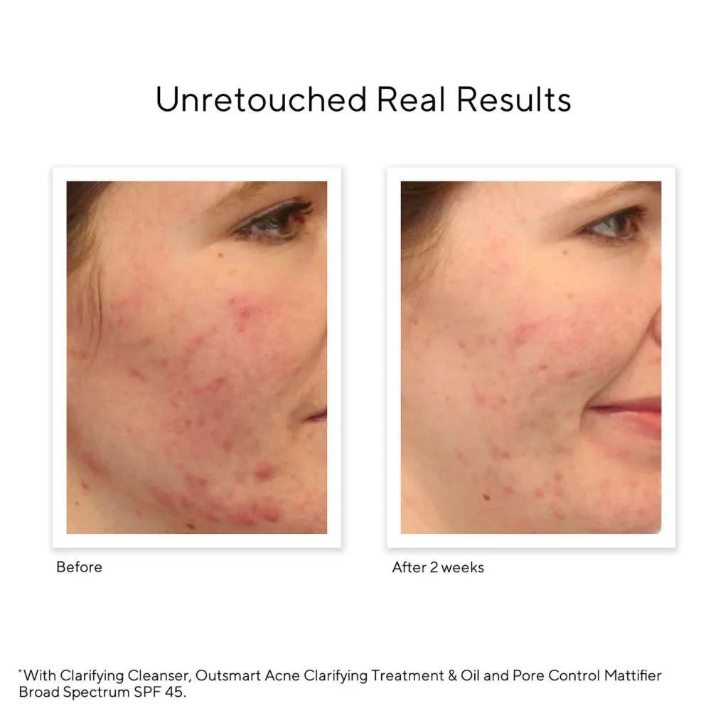 best face wash for hormonal acne