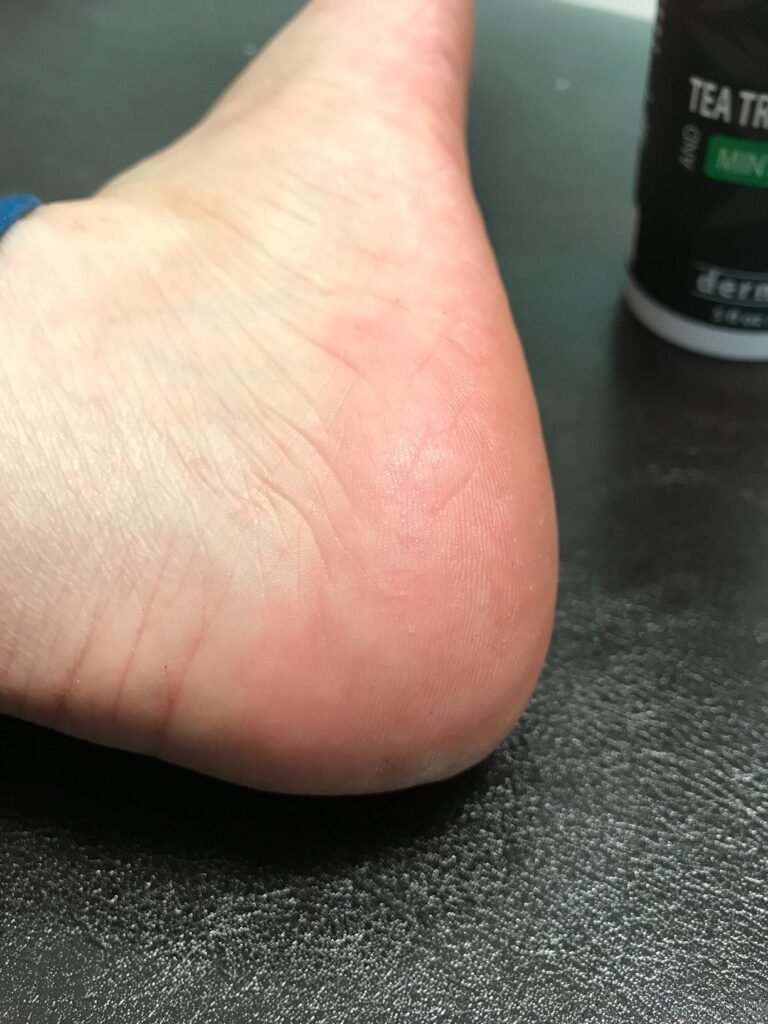 Best Organic Foot Creams for Calluses 2025