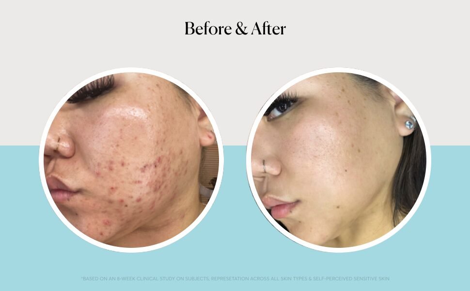 Best Hyaluronic Acid Serum for Pores in 2025 | Minimize Large Pores & Hydrate Skin 11 Best Hyaluronic Acid Serum for Pores