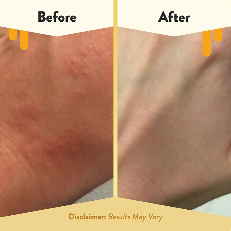 Best Organic Body Lotions for Eczema