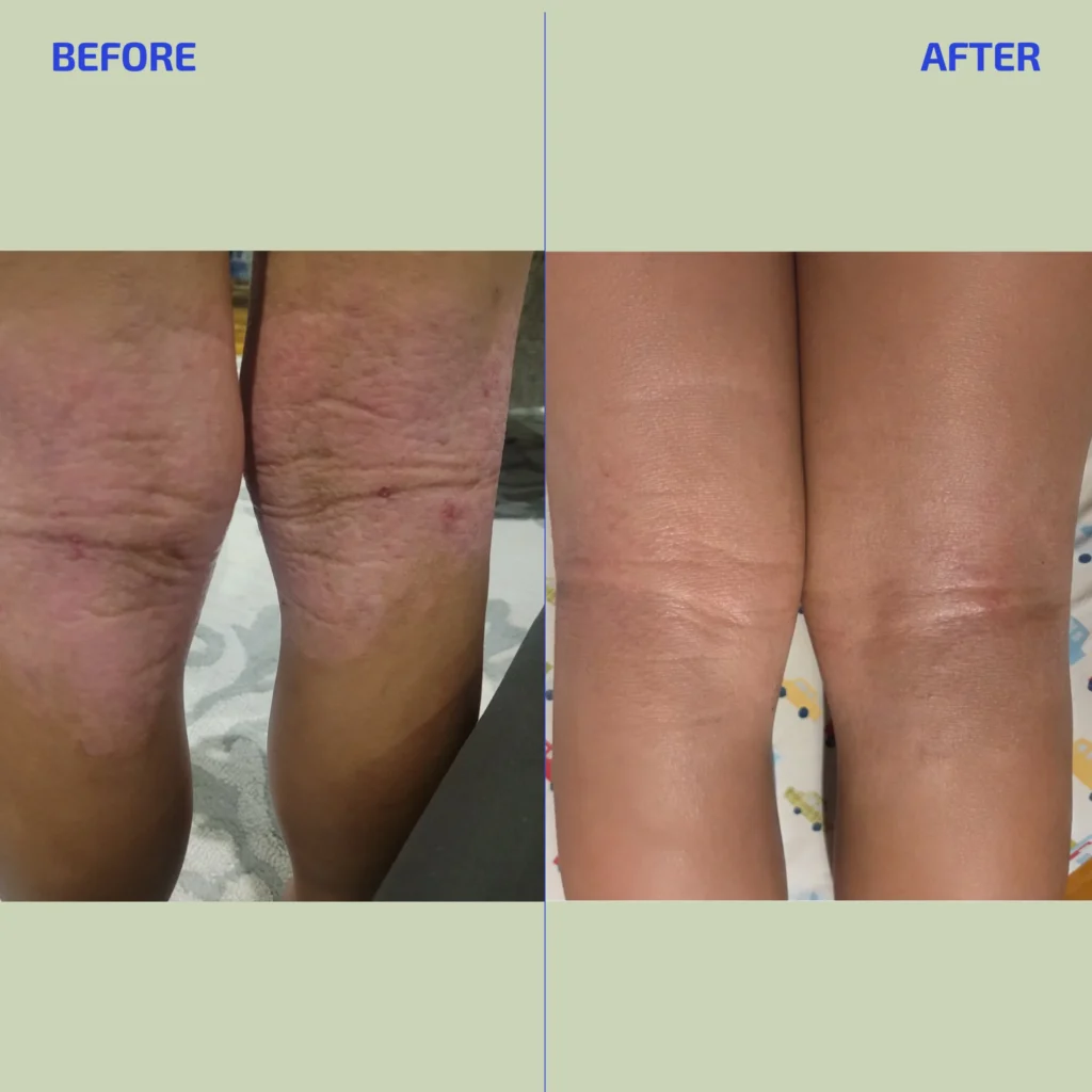 Best Organic Body Lotions for Eczema