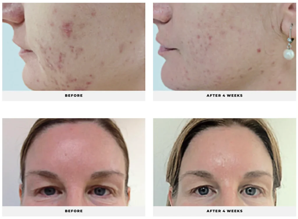 Best Natural Tea Tree Oils for Blackheads 2025