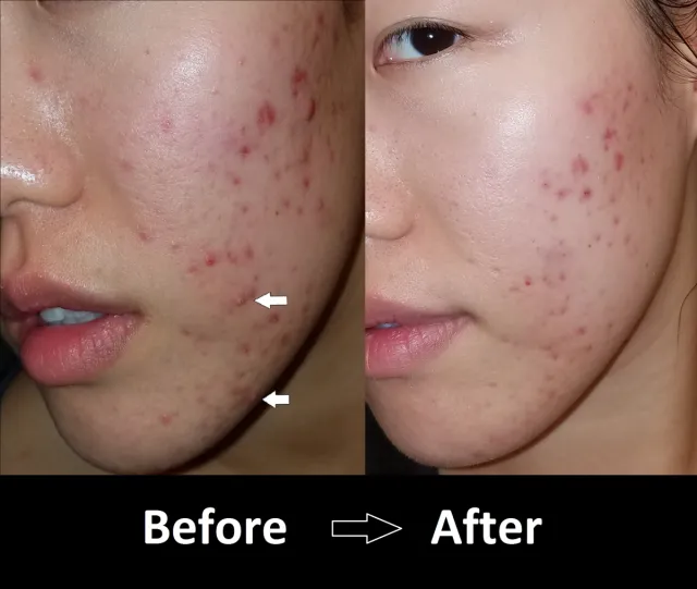 best face wash for hormonal acne