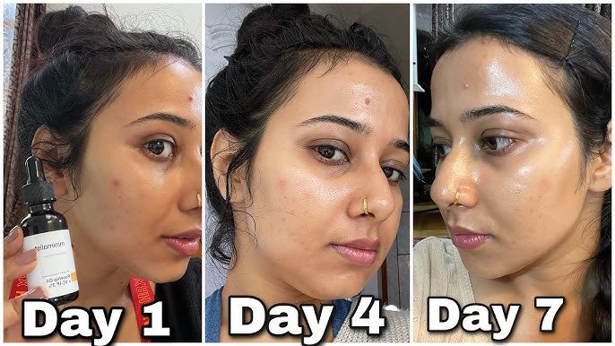 Best Natural Face Oils for Acne Scars in 2025