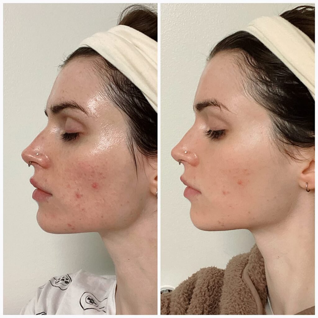 Best Anti-Blemish Night Masks 2025