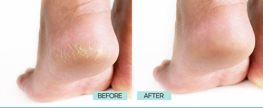 Best Vegan Foot Masks for Dry, Cracked Heels 2025 | Soften & Repair Naturally 9 Best Vegan Foot Masks for Dry