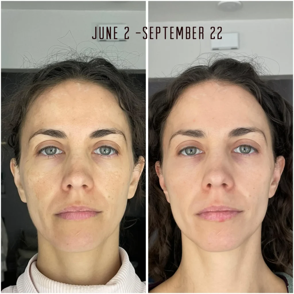 eucerine anti pigment results v0 hoic12nserrd1