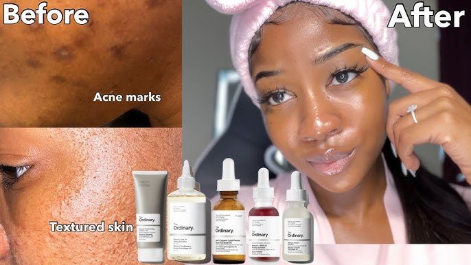 Best Products for Melasma 2025
