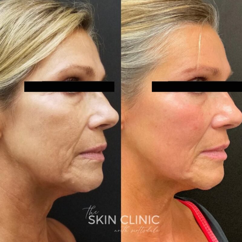 Barrier-Boosting Ampoules for Post-Procedure Skin