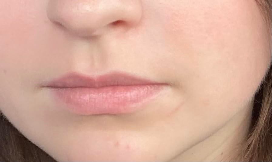 accutane before after