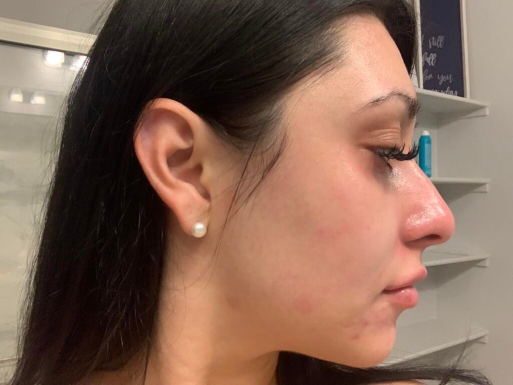 accutane before after