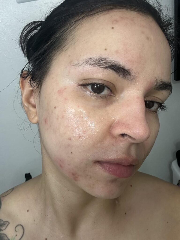 accutane before after