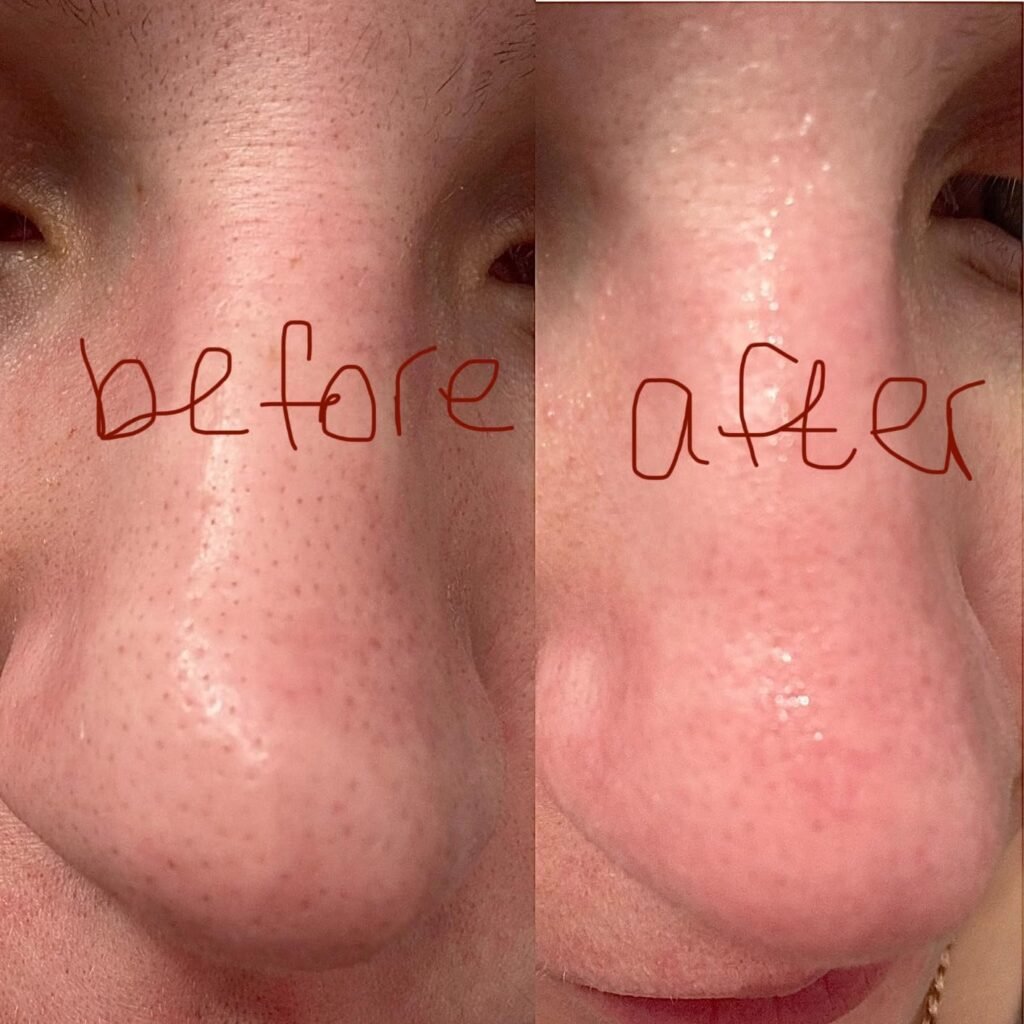 accutane before after