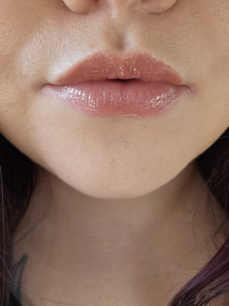 accutane before after