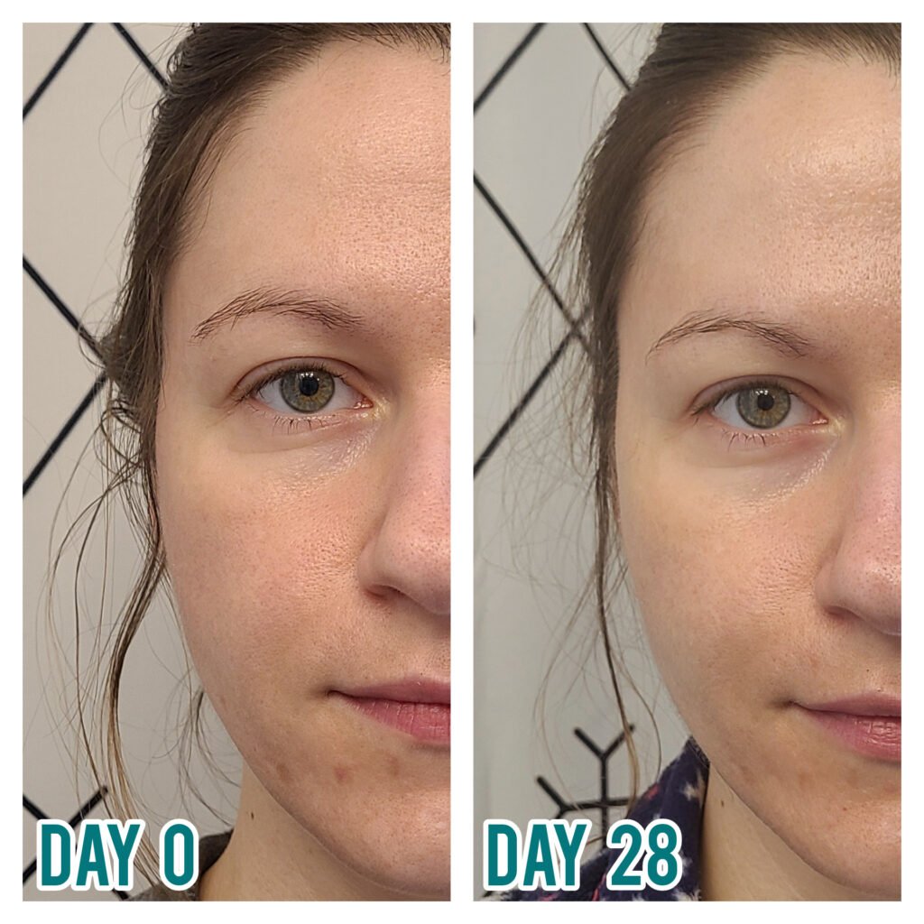 best moisturizer after chemical peel